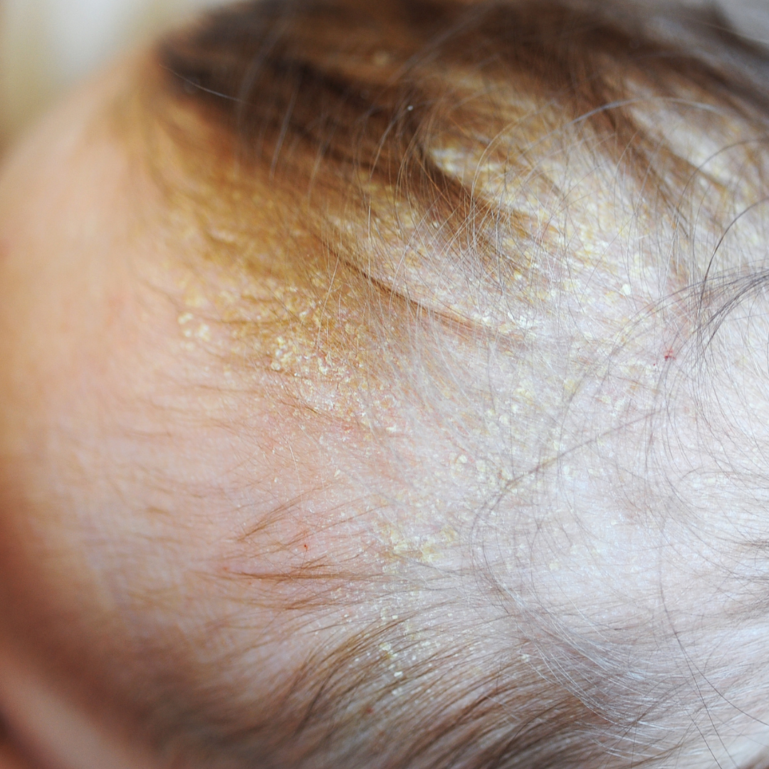 Crosta lattea in testa neonato - consigli e rimedi